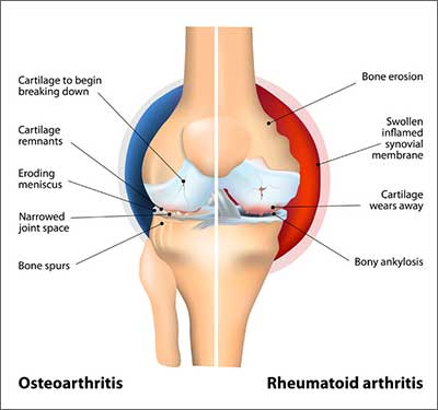 Comparison of Osteoarthritis and Rheumatoid Arthritis