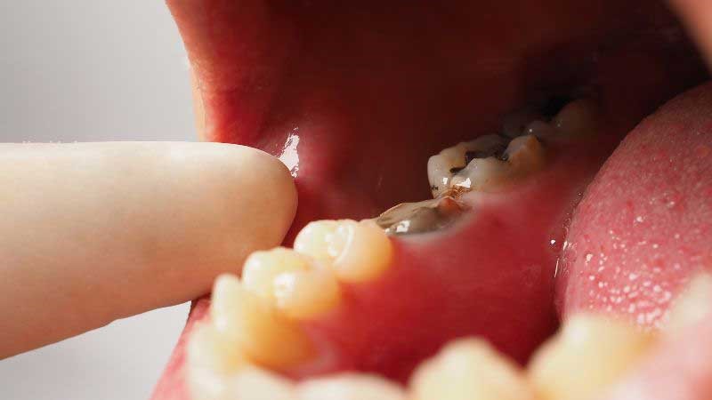Poor Oral Health Affect Senior's Health